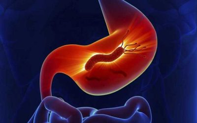 H. pylori Infection and Carcinoma Stomach