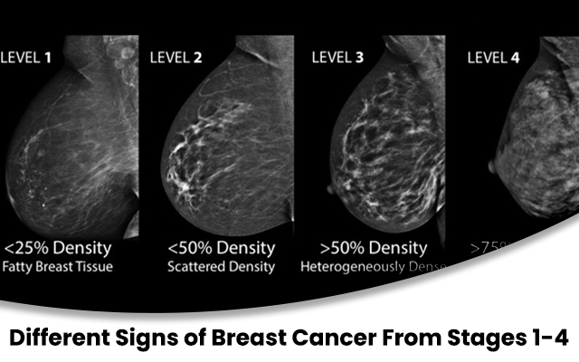 breast cancer 1st stage symptoms