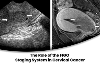 The Role of the FIGO Staging System in Cervical Cancer